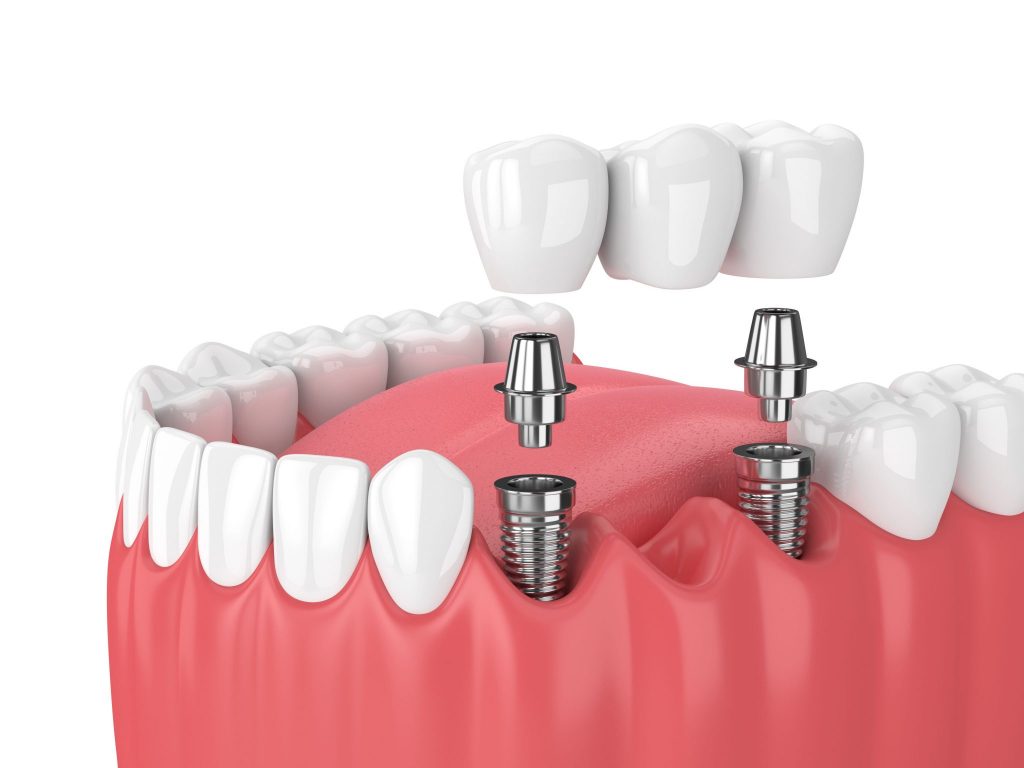 Dental-Implants